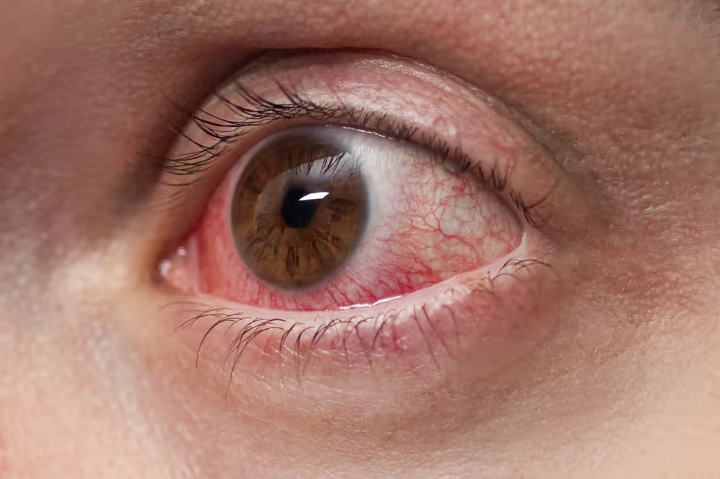 Close-up de olho com hiperemia conjuntival intensa — quadro típico de alergia ocular ativa. Close-up de olho com hiperemia conjuntival intensa — quadro típico de alergia ocular ativa.