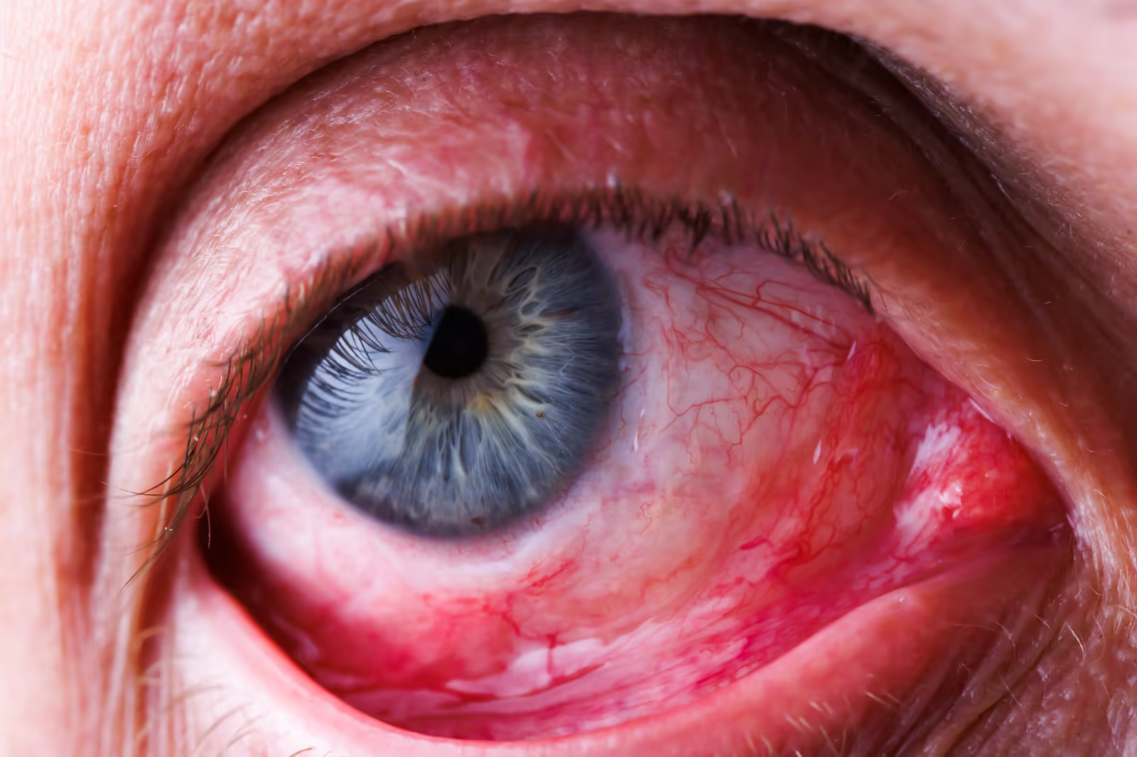 Olho com hiperemia e capilares dilatados, apresentação típica de alergia ocular ativa com coceira e vermelhidão. Olho com hiperemia e capilares dilatados, apresentação típica de alergia ocular ativa com coceira e vermelhidão.