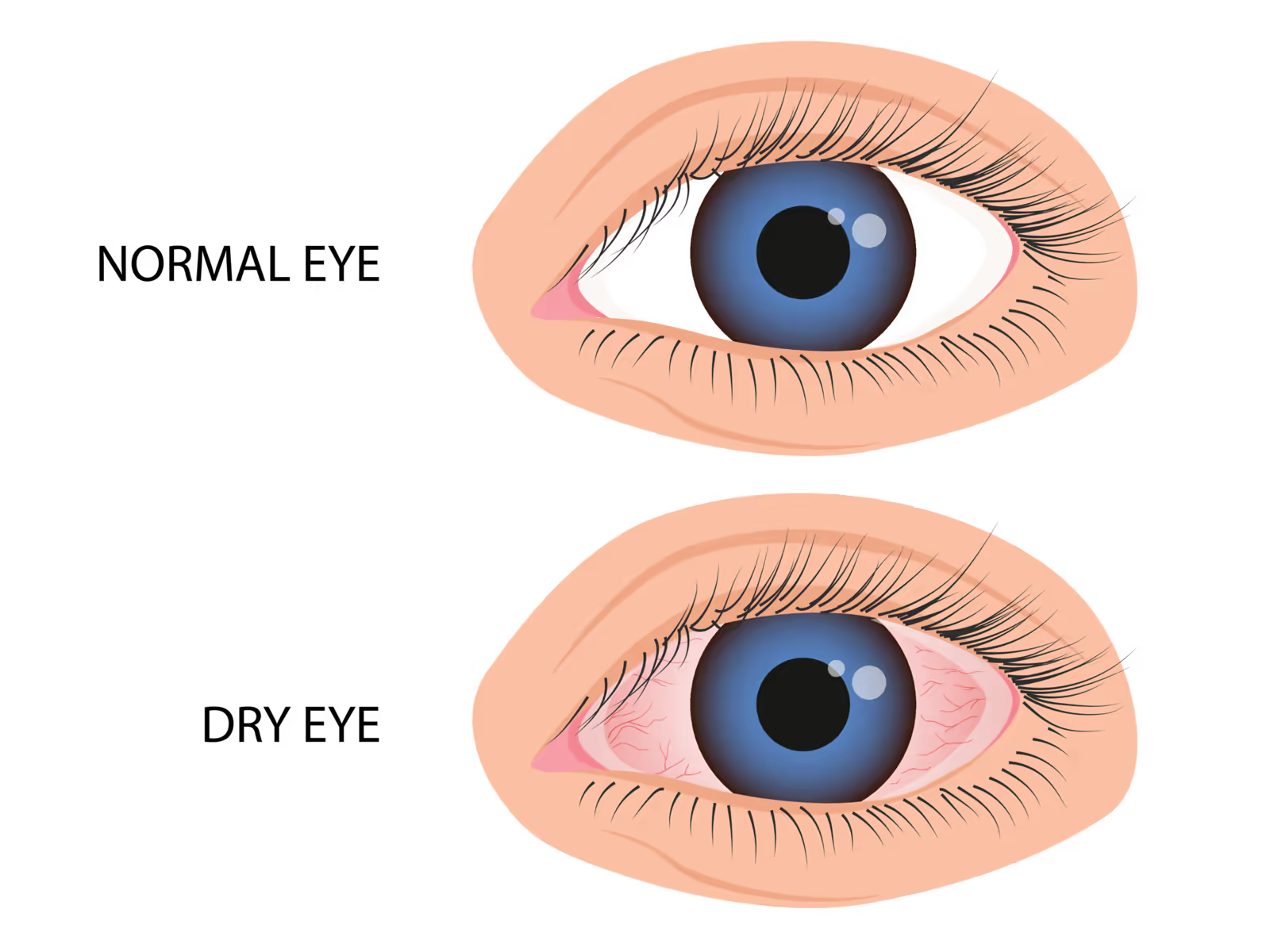 Comparação entre olho saudável e quadros de olho seco, ceratite e alergia ocular. Comparação entre olho saudável e quadros de olho seco, ceratite e alergia ocular.