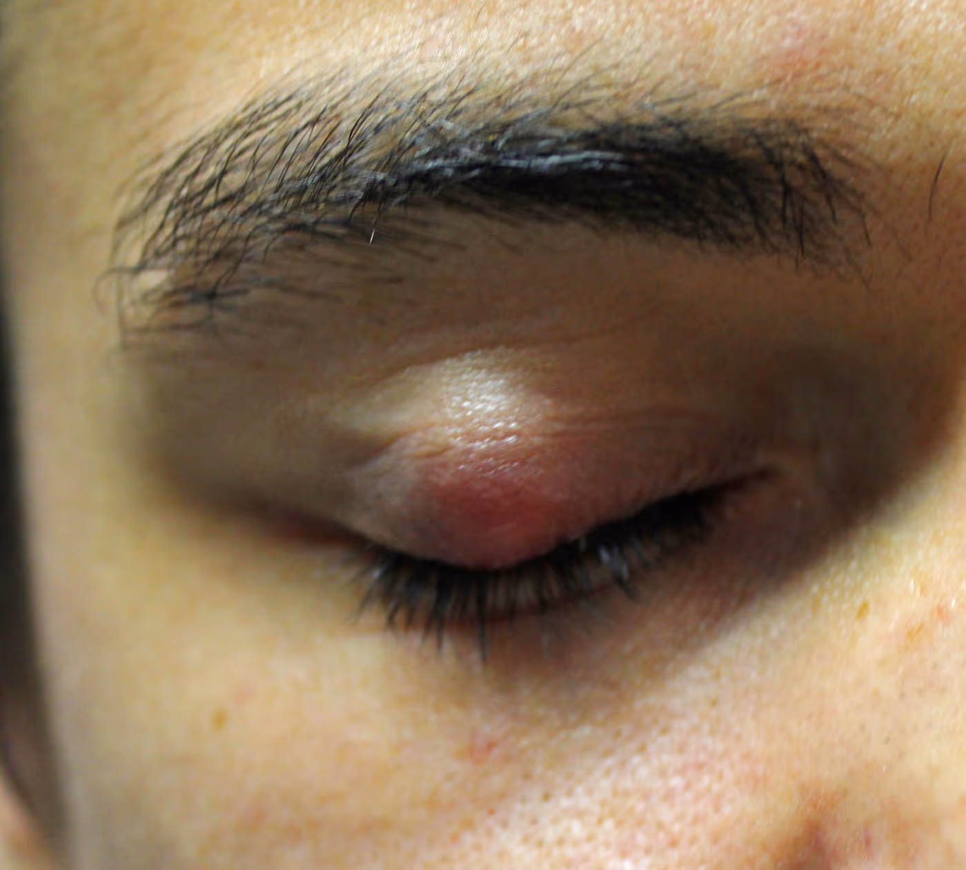 Pálpebra superior com calázio proeminente — nódulo indolor característico da doença. Pálpebra superior com calázio proeminente — nódulo indolor característico da doença.