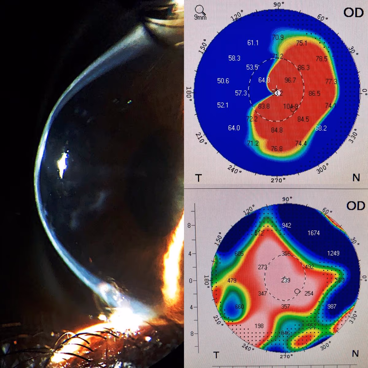 Caso de ceratocone avançado com afinamento corneano gravíssimo (200 micrômetros) e curvatura máxima acima de 80–100 dioptrias.