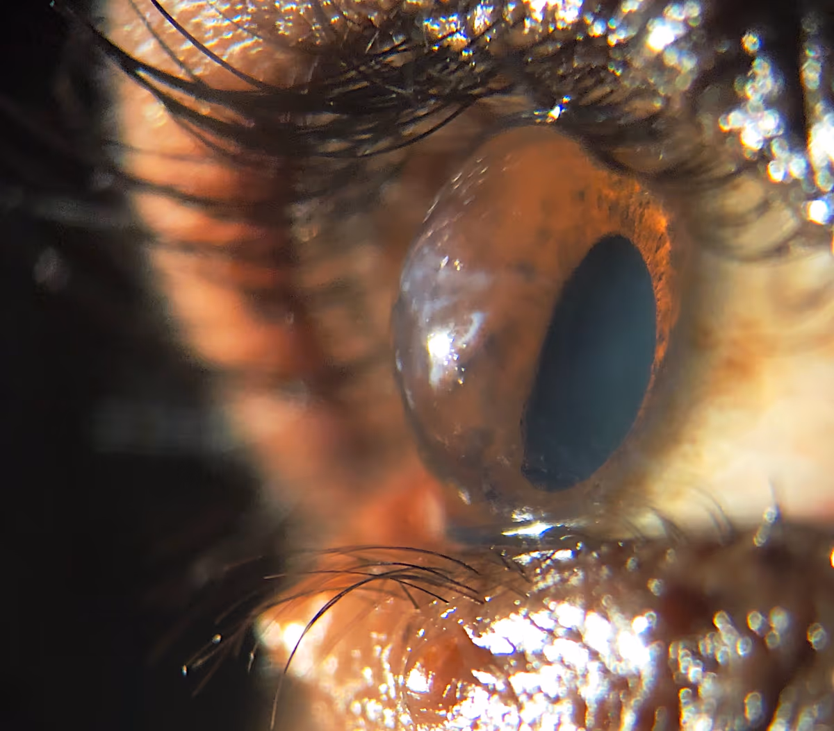 Cicatriz corneana em paciente com sequela de ceratocone avançado — indicação de transplante. Documentado pelo Dr. Lucca Ortolan Hansen.