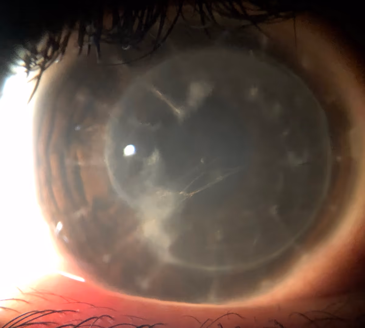 Complicação de transplante de córnea com cicatrização após ceratite infecciosa por cuidado inadequado no pós-operatório — caso externo documentado pelo Dr. Lucca Ortolan Hansen.