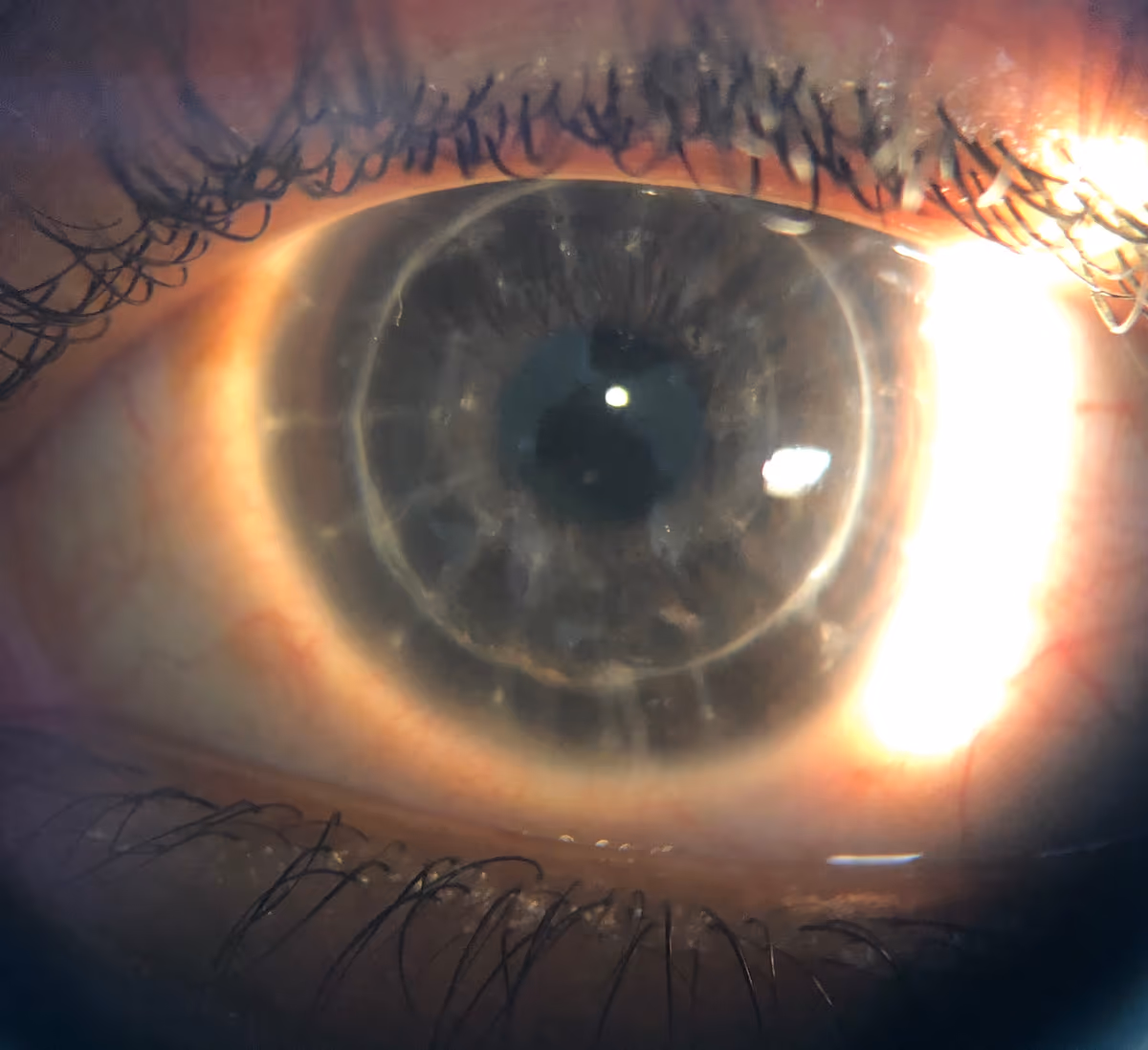 Transplante de córnea bem-sucedido em paciente com ceratocone — a córnea doadora transparente e o enxerto estável. Documentado pelo Dr. Lucca Ortolan Hansen.