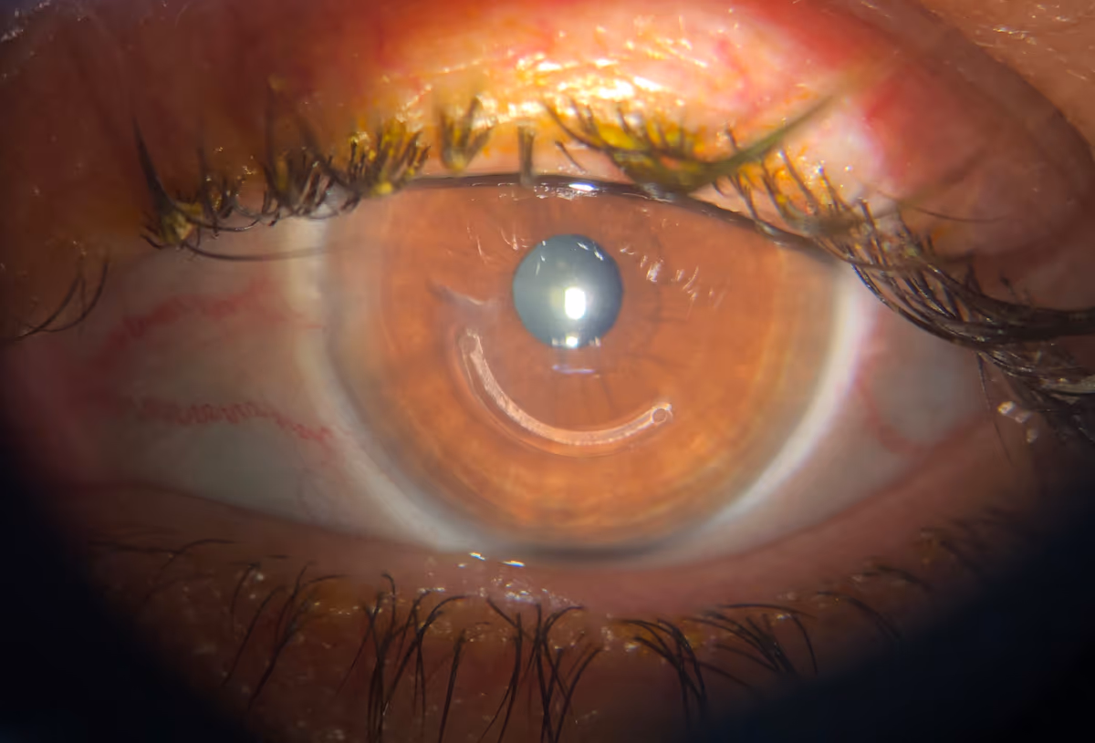 Implante de anel intraestromal (Anel de Ferrara) em paciente com ceratocone moderado — realizado pelo Dr. Lucca Ortolan Hansen durante residência no HC-USP pela técnica manual.