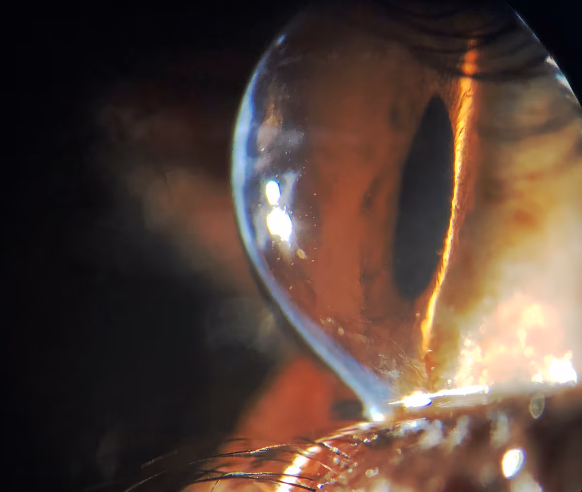 Córnea com ceratocone avançado mostrando cicatrização e afinamento extremo (200μm).