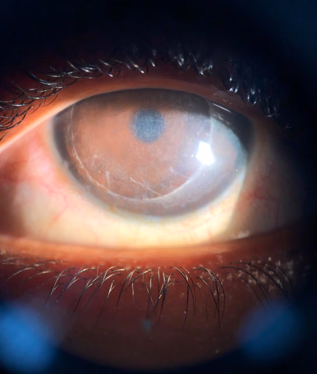 Falência endotelial da córnea — edema corneano com perda de transparência. Documentado pelo Dr. Lucca Ortolan Hansen.