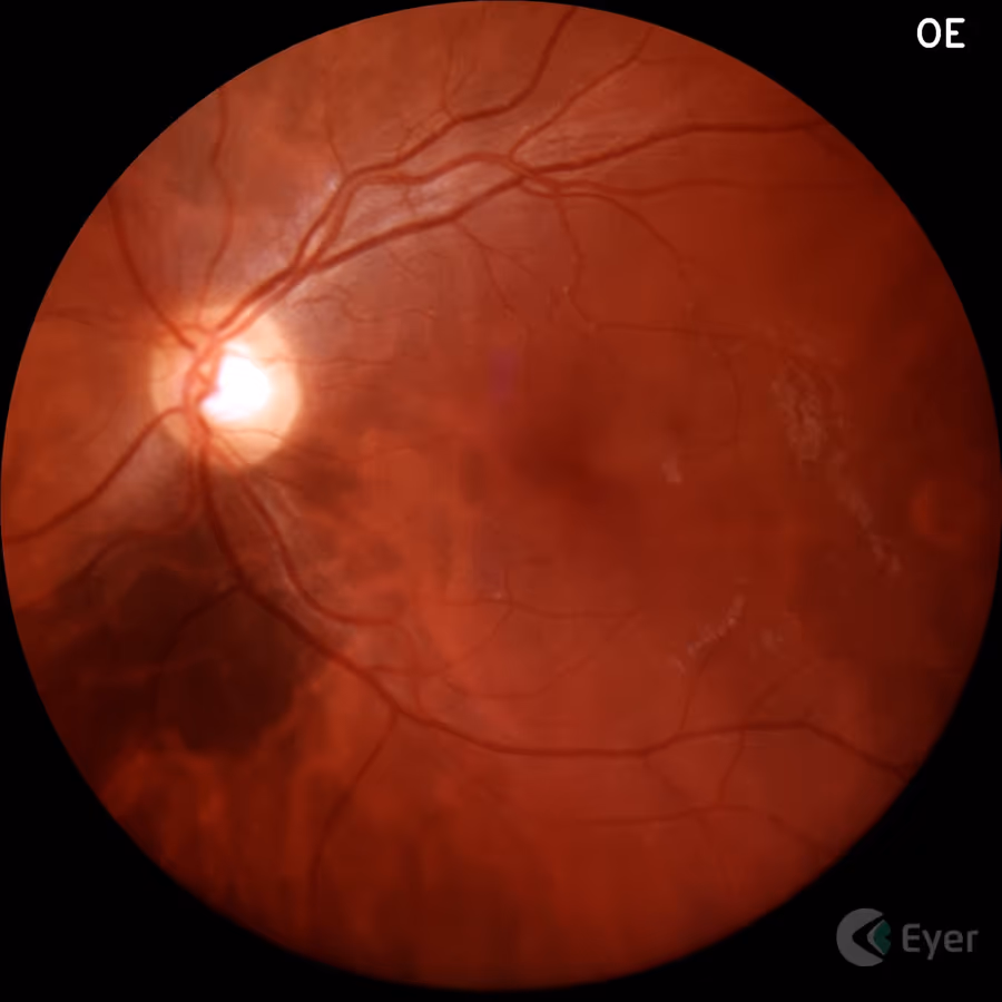 Retinografia mostrando nevus de coroide — lesão pigmentada plana na retina periférica.