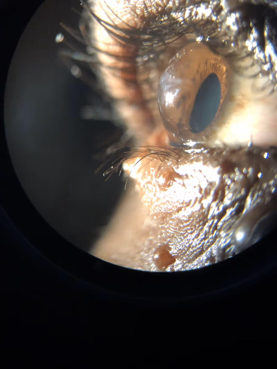 Dr. Lucca Ortolan Hansen — pesquisador e autor do estudo sobre crosslinking e ceratocone no SUS.