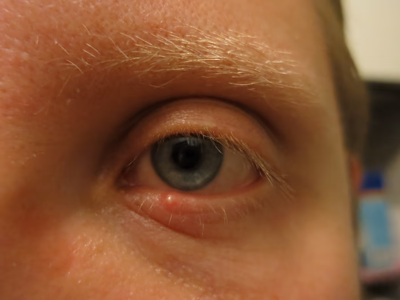 Pálpebra com terçol — pústula vermelha característica na borda dos cílios. Pálpebra com terçol — pústula vermelha característica na borda dos cílios.