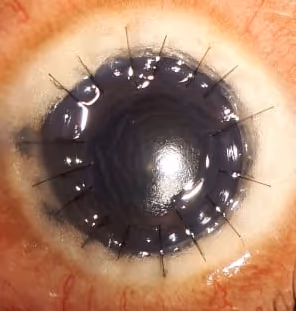 Transplante lamelar anterior profundo (DALK) — técnica que preserva o endotélio do paciente.