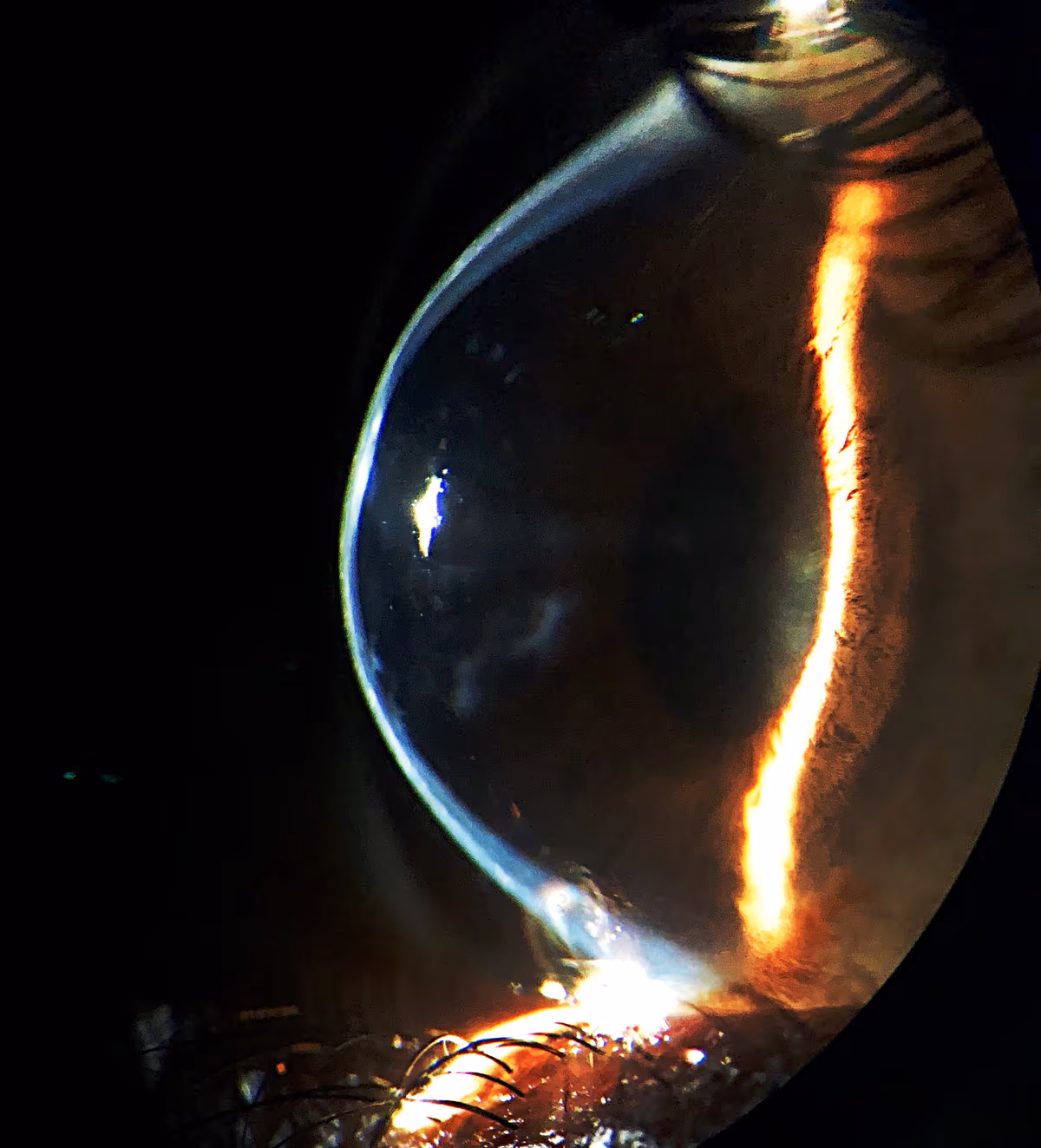 Ceratocone avançado com córnea extremamente afinada — nestes casos o implante de anel não é viável e o transplante de córnea pode ser indicado.