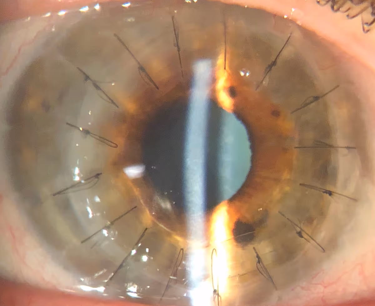 Transplante de córnea realizado pela Dra. Nicole Bulgarão na Ortolan Oftalmologia.