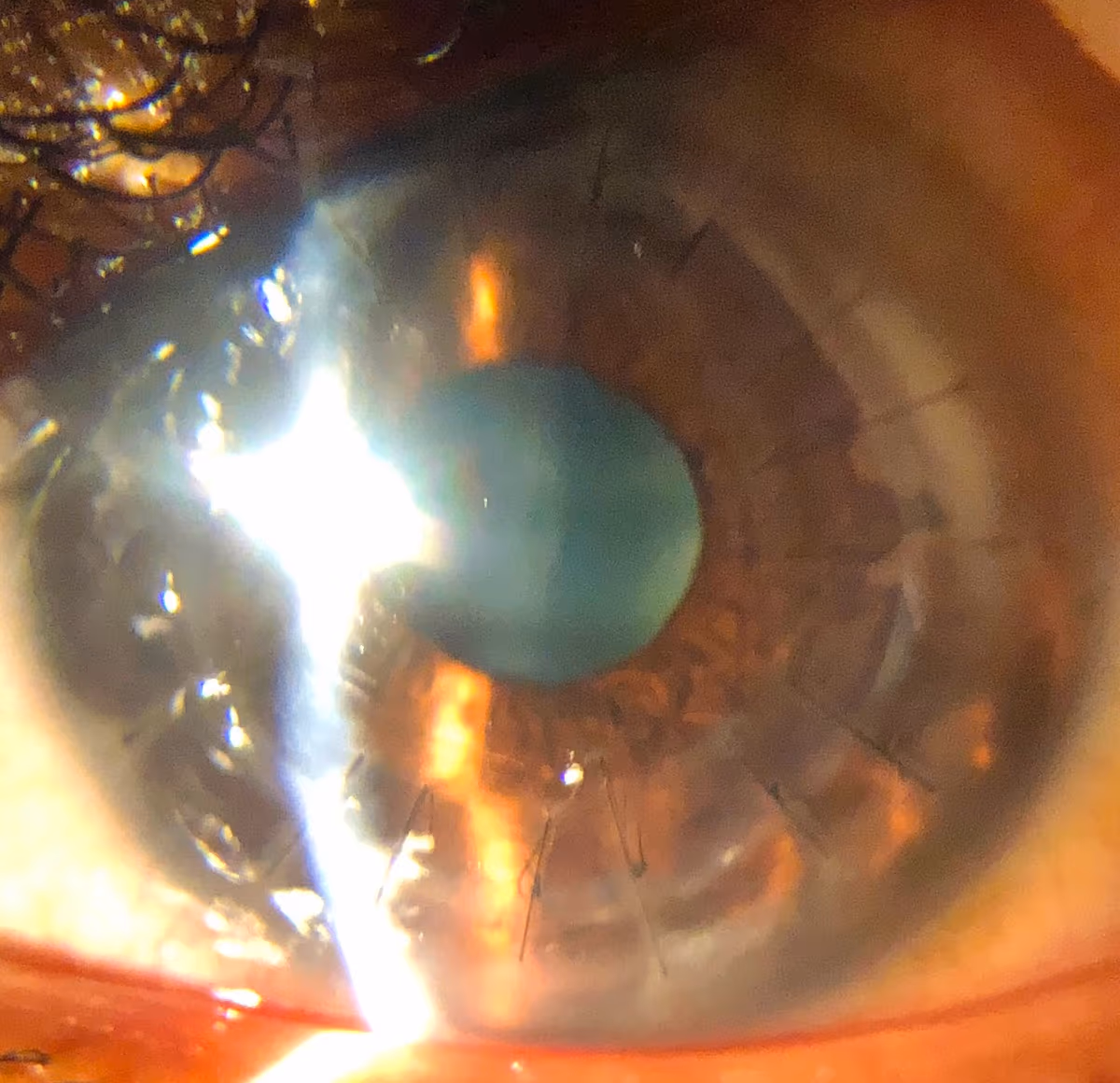 Pós-operatório de transplante de córnea pela Dra. Nicole Bulgarão.