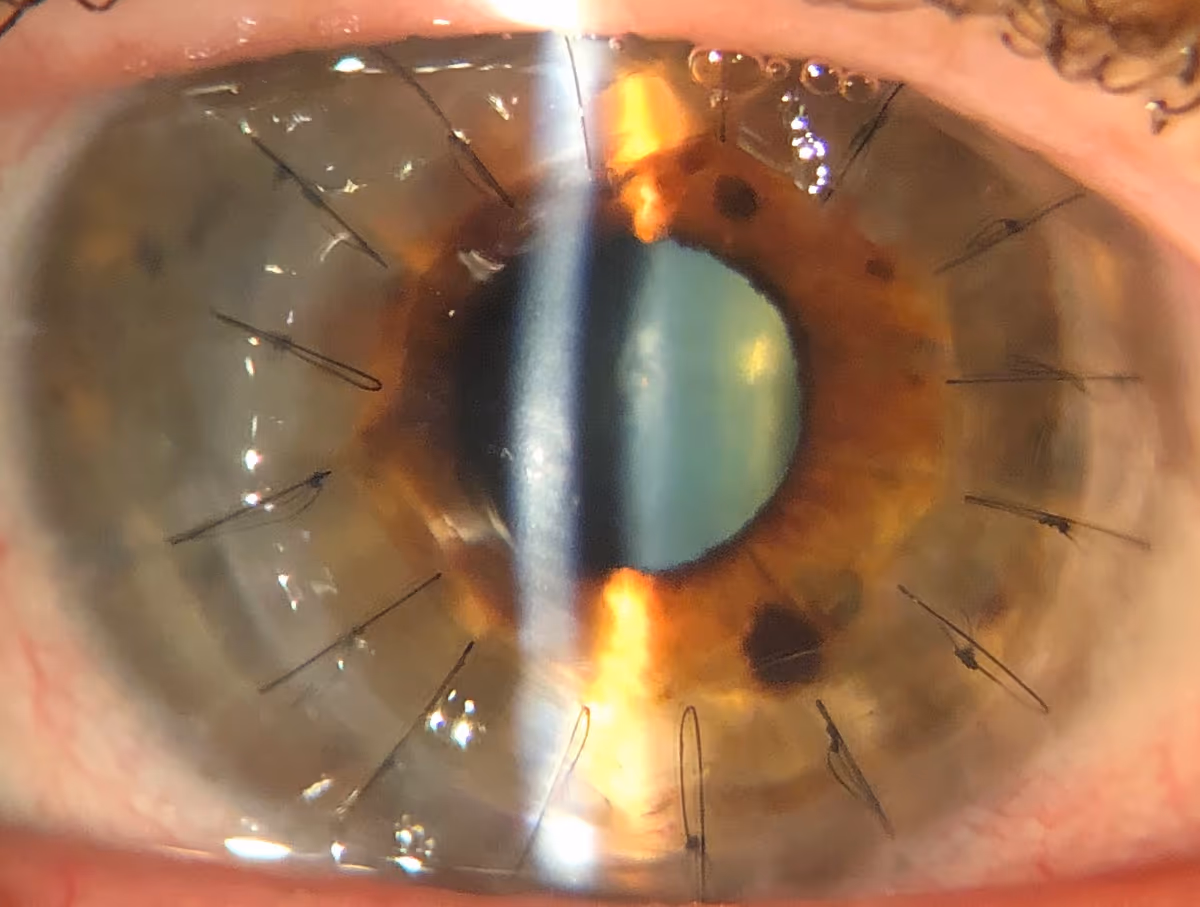 Transplante penetrante de córnea realizado pela Dra. Nicole Bulgarão.