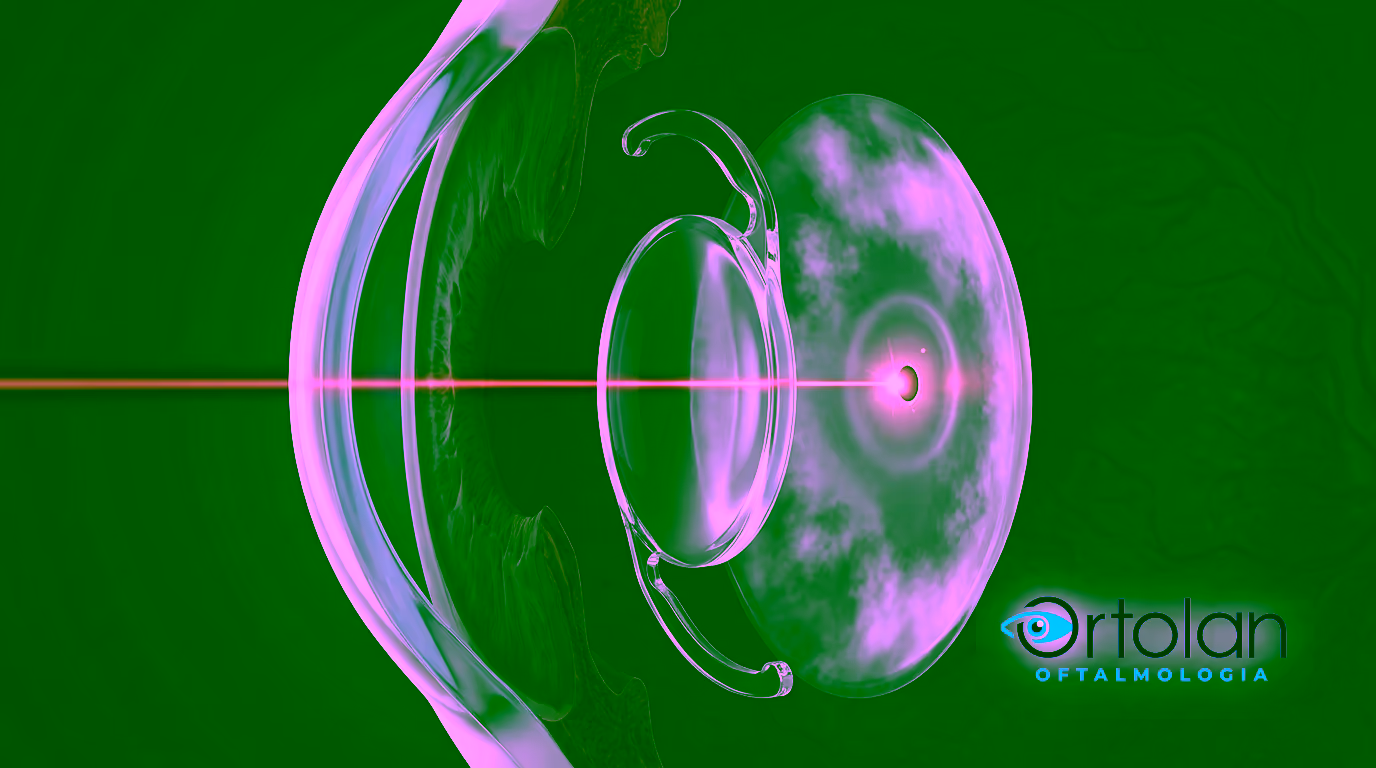 Ilustração 3D em corte do olho durante a capsulotomia: o feixe do laser Nd:YAG atravessa a lente intraocular transparente sem danificá-la e converge num único ponto de foco atrás dela, sobre a cápsula posterior opaca. Ilustração 3D em corte do olho durante a capsulotomia: o feixe do laser Nd:YAG atravessa a lente intraocular transparente sem danificá-la e converge num único ponto de foco atrás dela, sobre a cápsula posterior opaca.