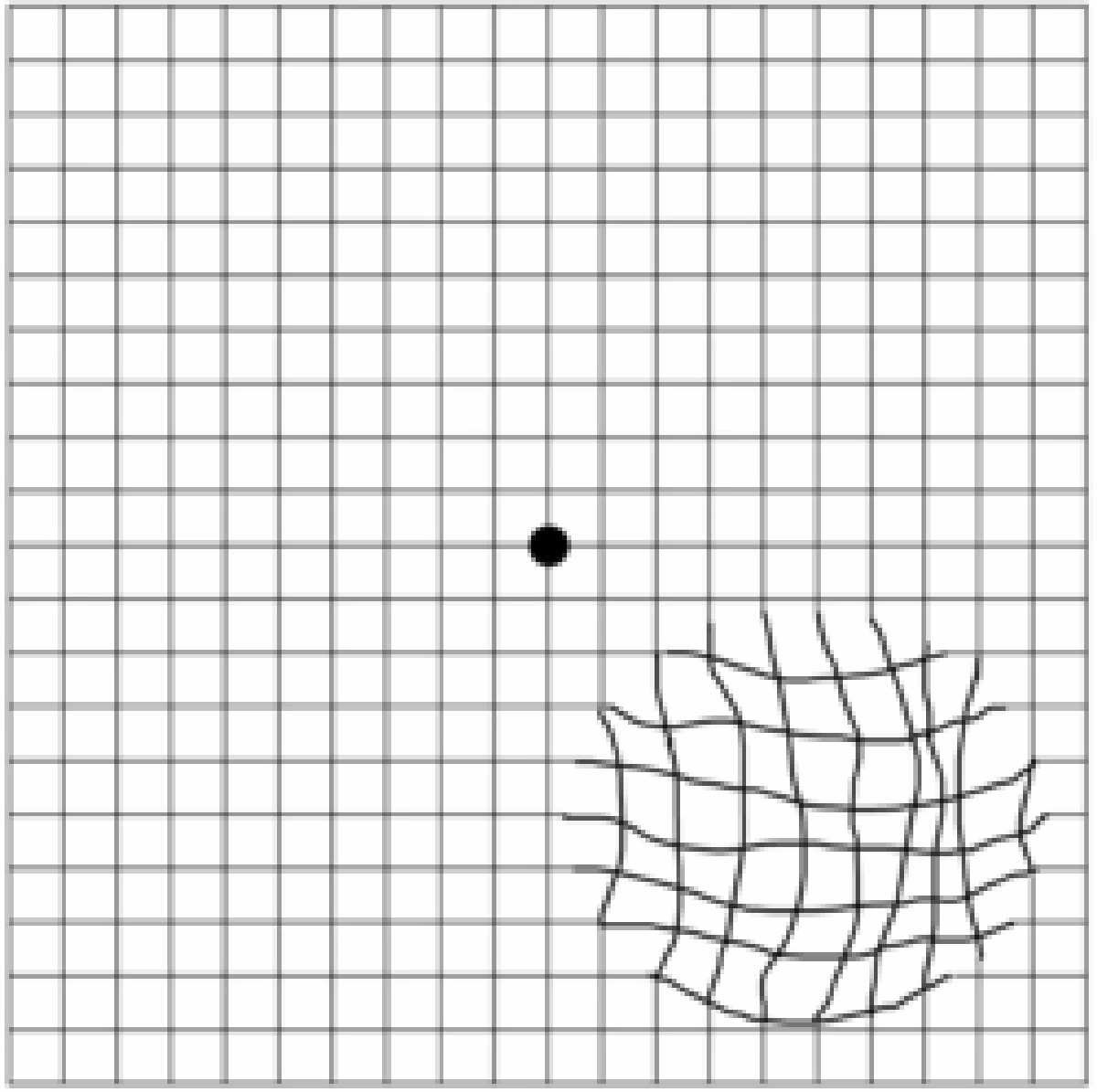 Cirurgia de membrana epirretiniana (MER)