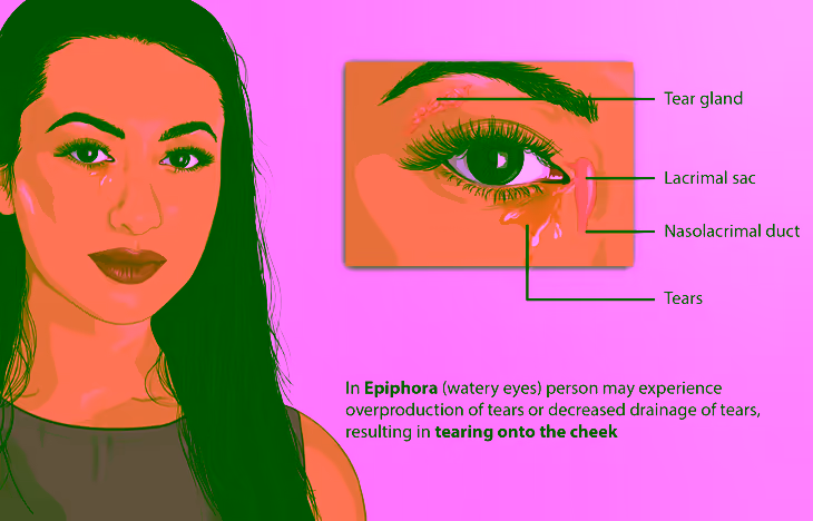 Esquema do sistema lacrimal mostrando a glândula lacrimal, o saco lacrimal e o ducto nasolacrimal, com a lágrima transbordando pela face quando a drenagem falha. Fonte: MyUpchar via Wikimedia Commons, CC BY-SA 4.0. Esquema do sistema lacrimal mostrando a glândula lacrimal, o saco lacrimal e o ducto nasolacrimal, com a lágrima transbordando pela face quando a drenagem falha. Fonte: MyUpchar via Wikimedia Commons, CC BY-SA 4.0.