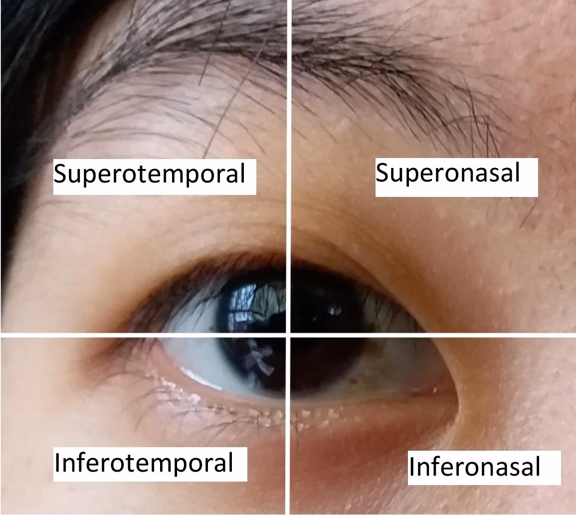 Diagrama dos quatro quadrantes do olho direito — superotemporal, superonasal, inferotemporal, inferonasal.
