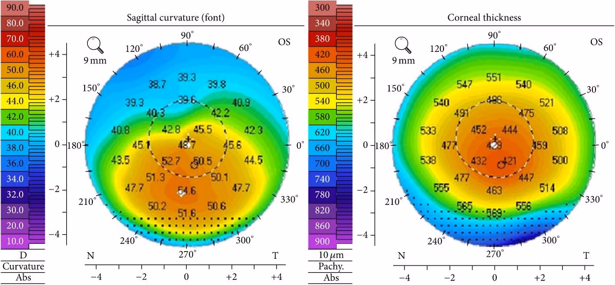 Topografia corneana mostrando ceratocone estágio II com afinamento inferior.
