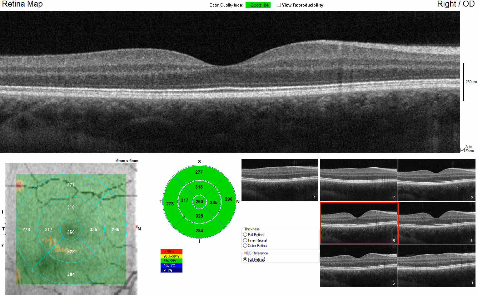 OCT de mácula saudável, com a depressão foveal normal e as camadas retinianas bem organizadas.