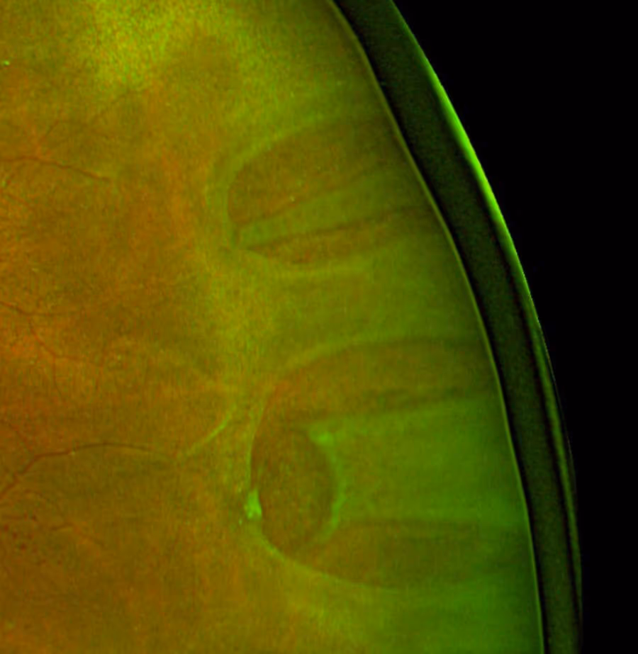 Ilustração de descolamento regmatogênico com rasgadura em ferradura.