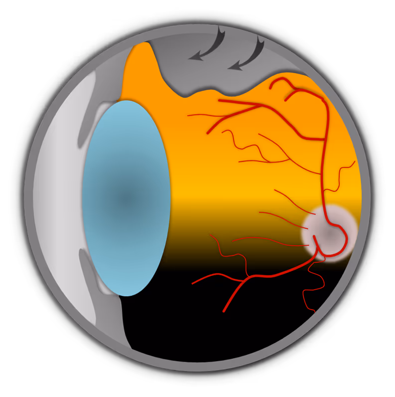 Cirurgia de descolamento de retina