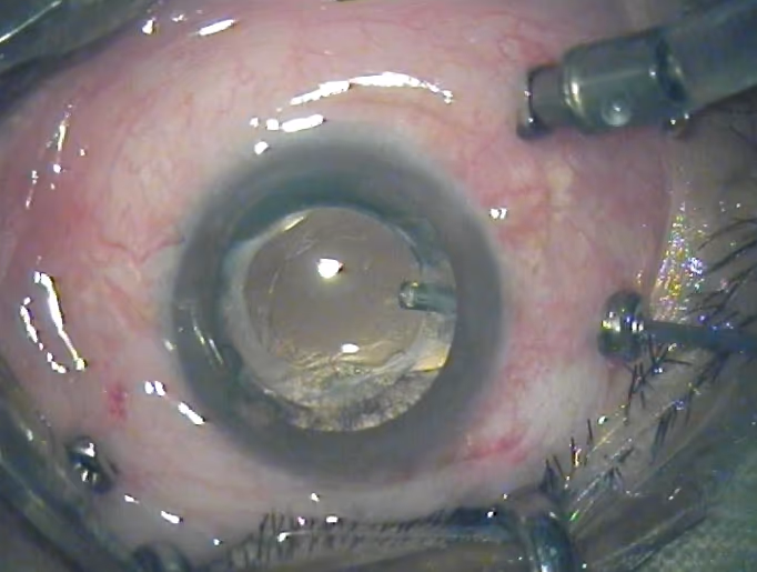 Vitrectomia 23 gauge em andamento — cirurgião e instrumentos microcirúrgicos durante vitrectomia via pars plana.