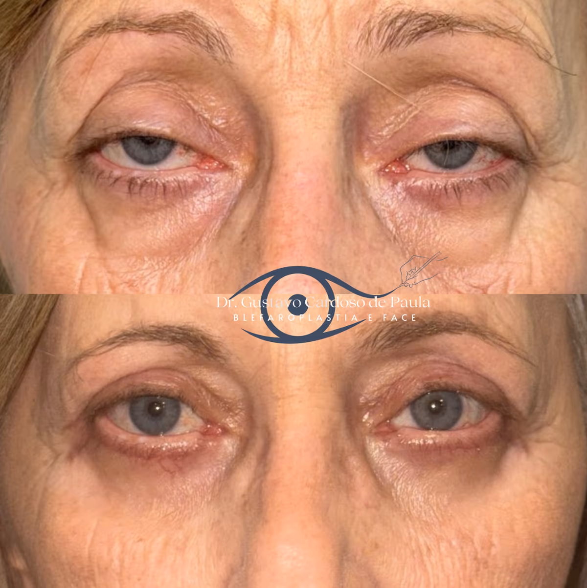 Caso clínico de blefaroplastia estruturada — antes e depois por Dr. Gustavo de Paula.