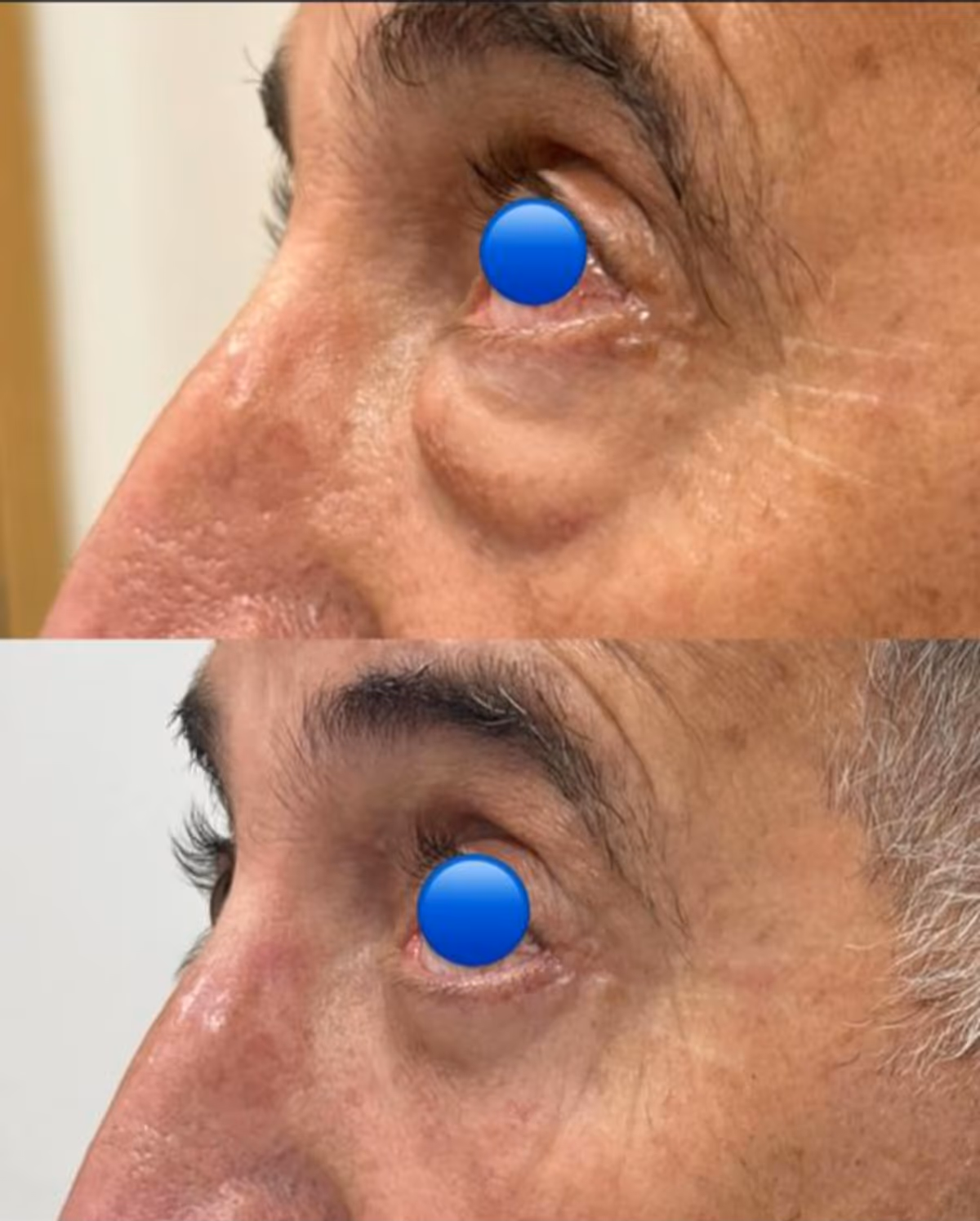 Antes e depois de blefaroplastia inferior apenas — remoção de bolsas de gordura proeminentes.