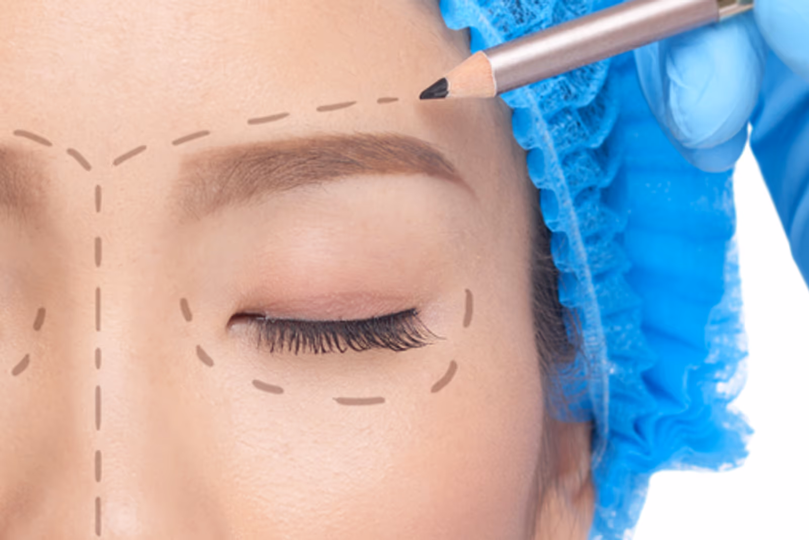 Close-up de uma pessoa com marcações pré-operatórias ao redor das pálpebras antes de uma cirurgia palpebral. Close-up de uma pessoa com marcações pré-operatórias ao redor das pálpebras antes de uma cirurgia palpebral.