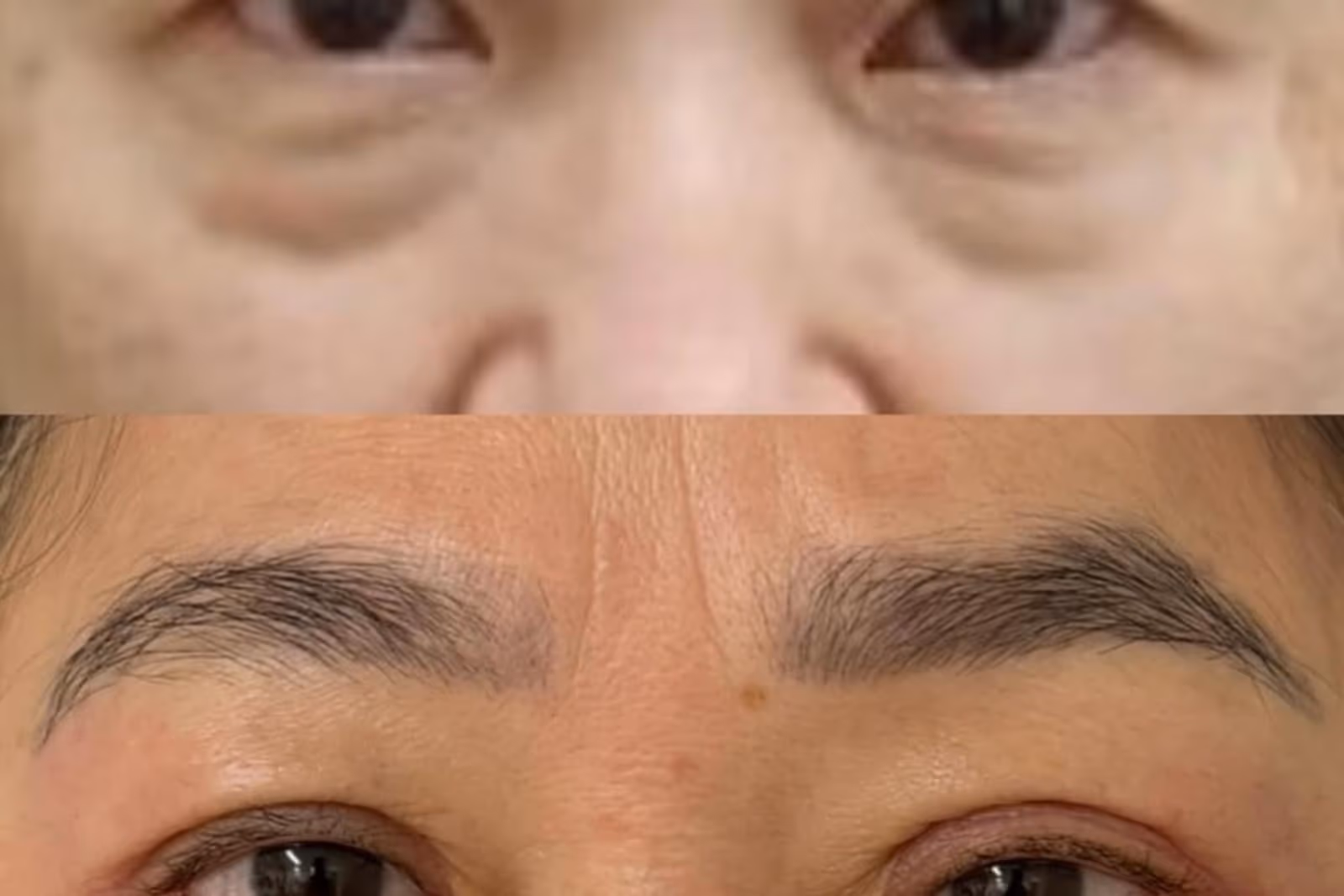 Comparação clínica aproximada dos olhos de uma pessoa com diferença na altura das pálpebras superiores. Comparação clínica aproximada dos olhos de uma pessoa com diferença na altura das pálpebras superiores.