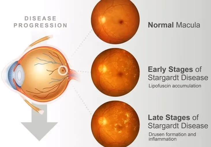 Foto mostrando sinais dos estágios da doença de Stargardt