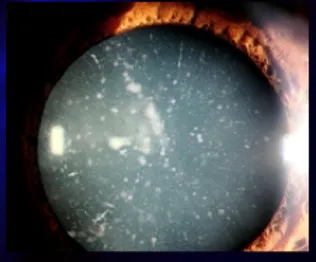 Catarata causada pelo uso prolongado de Amiodarona.