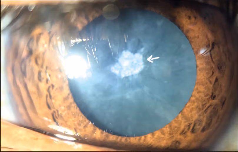 Catarata Diabética: ocorre devido a alta concentração de açúcar no sangue.