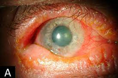 Conjuntivite Atópica com Inchaço das Pálpebras, Olho Vermelho e alteração da Córnea (ceratoconjuntivite atópica).