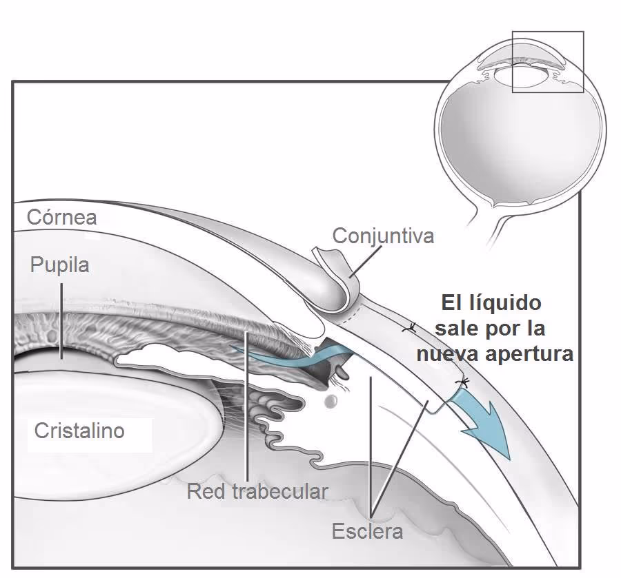 Legenda: desenho esquemático demonstrando o fluxo do humor aquoso na cirurgia de Trabeculectomia.
