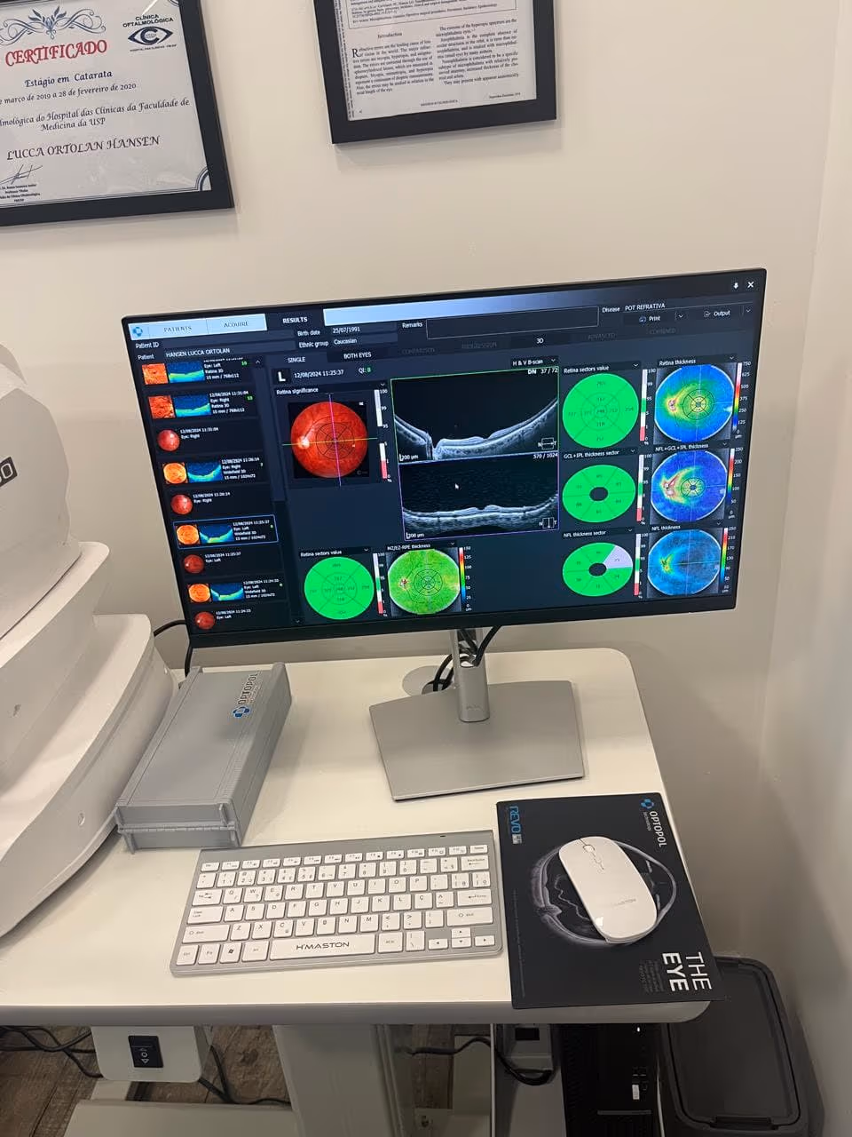 Análise da Mácula do Olho - Região Central da Visão, responsável pela visão de cores e a visão de detalhes. Muito acometida em certas doenças como a degeneração macular relacionadade à idade.