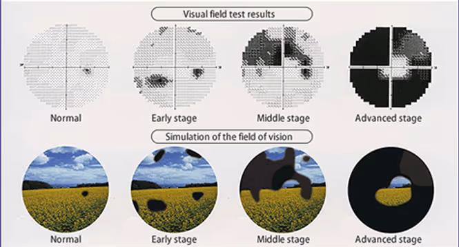 Foto correlacionando o exame de Campo Visual e a Visão do Paciente.