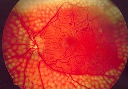 Foto mostrando fotocoagulação da retina para tratamento da retinopatia diabética.