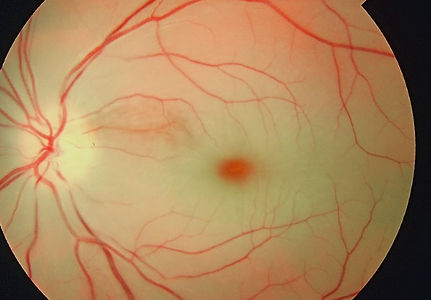 Foto mostrando o sinal de mácula em cereja na oclusão de artéria central.