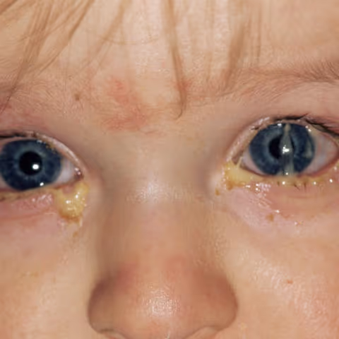 Conjuntivite Bacteriana: a secreção purulenta é evidente.