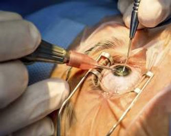 Cirurgia de Facoemulsificação (Cirurgia de Catarata).