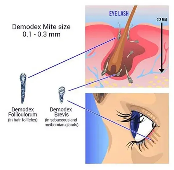 Ácaros Demodex dentro das glândulas da margem palpebral.