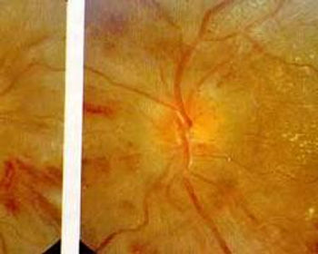 Caso de Retinopatia Hipertensiva severa.
