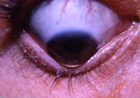 Imagem mostrando caso severo de ceratocone, com o aparecimento do sinal de Munson - sinal que evidencia ao olho nú a presença de ceratocone grave. O Ceratocone é uma doença que causa progressivo aumento da curvatura da córnea e seu afilamento, de maneira assimétrica geralmente (atinge mais um dos olhos).