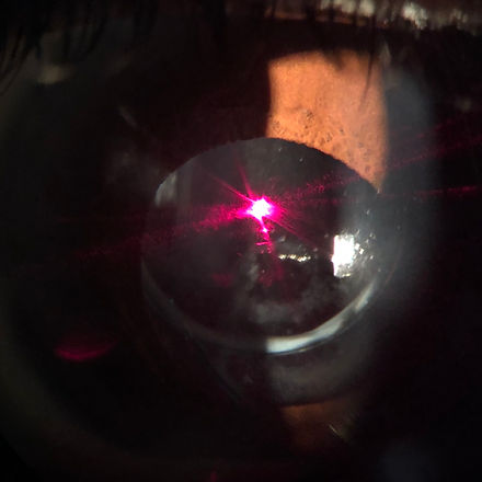 TÉCNICAS À LASER para Limpeza das Lentes Intraoculares (Capsulotomia à YAg Laser).