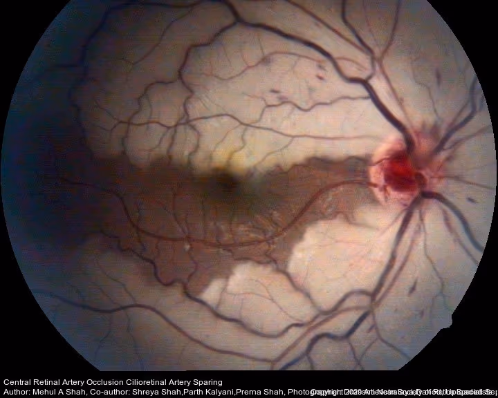 Oclusão da Artéria Centrral da Retina, mostrando a retina pálida. Ainda neste caso há circulação da artéria ciliorretiniana que nutre a mácula central.