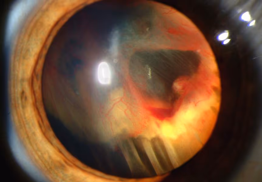 Foto mostrando hemorragia vítrea em paciente com descolamento de retina associado.