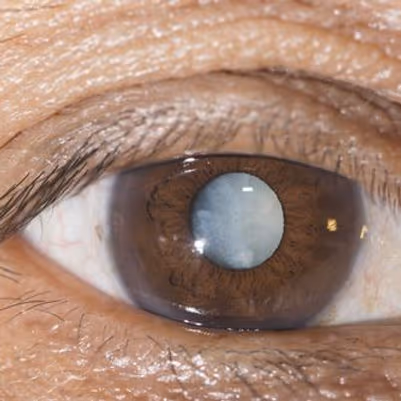 Catarata Senil em Paciente